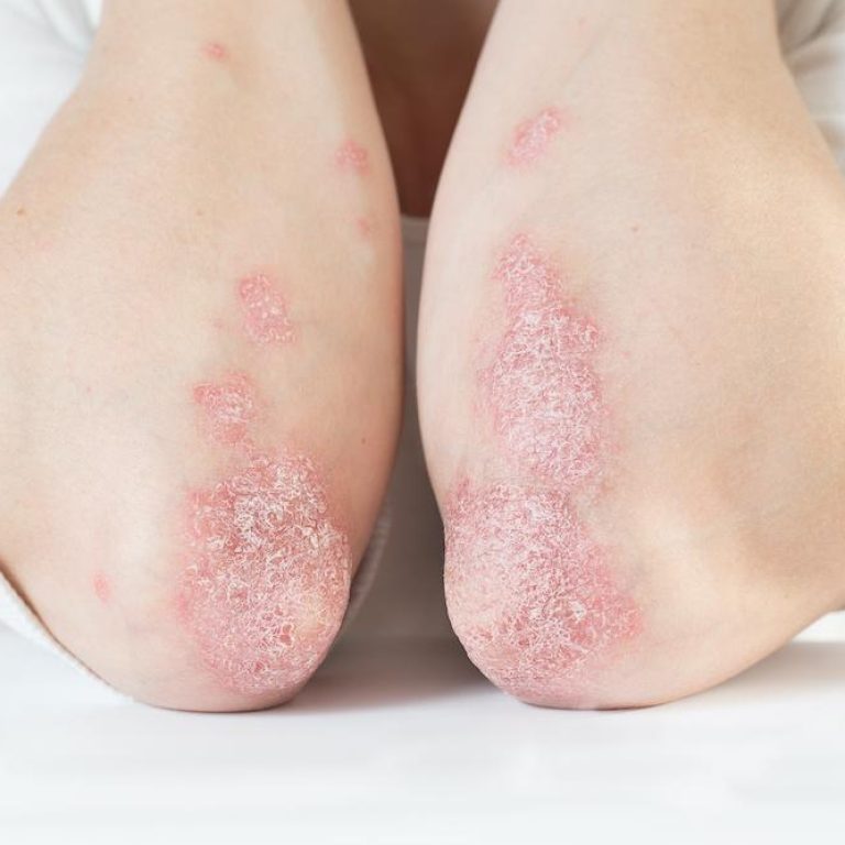Psoriasis