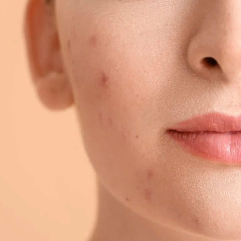 Acne and Spot Treatment