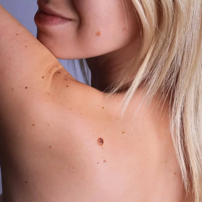 skin-tag-removal-in-toronto