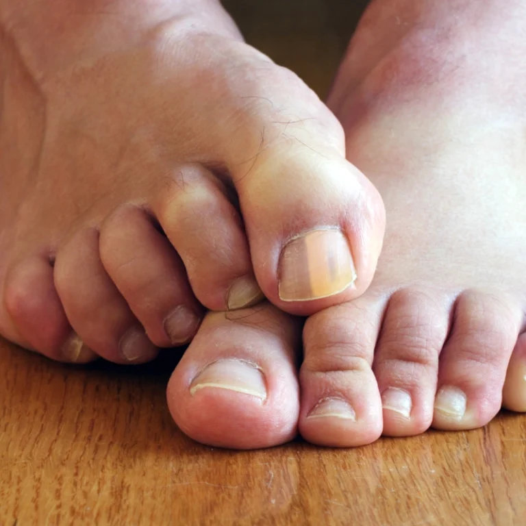Nail Fungus (Onychomycosis)